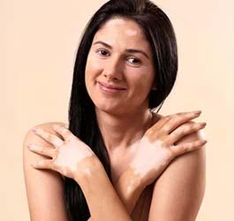 Embracing Vitiligo A Comprehensive Approach To Skin Pigmentation